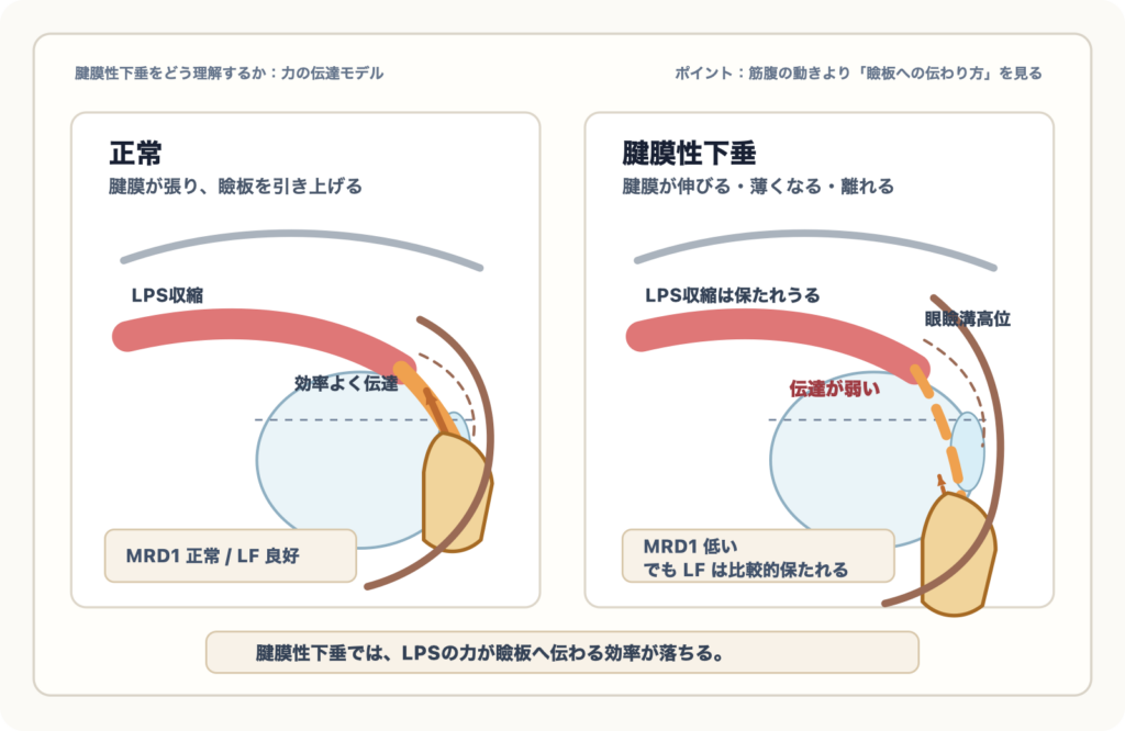 図3：腱膜性下垂における力の伝達低下